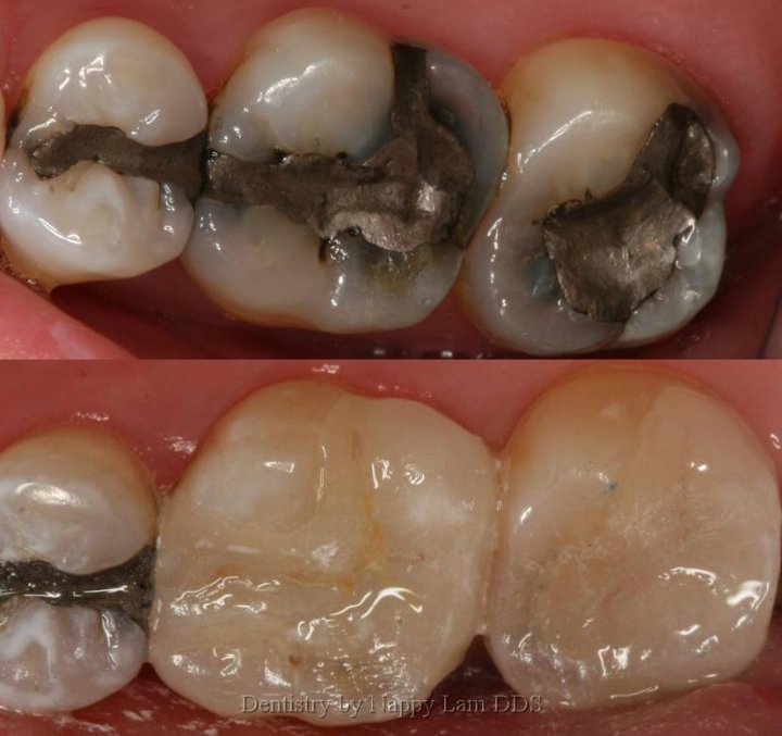 Old amalgams can be replaced with porcelain onlays