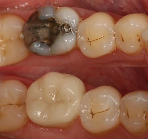 cerec crown replacing failing amalgam