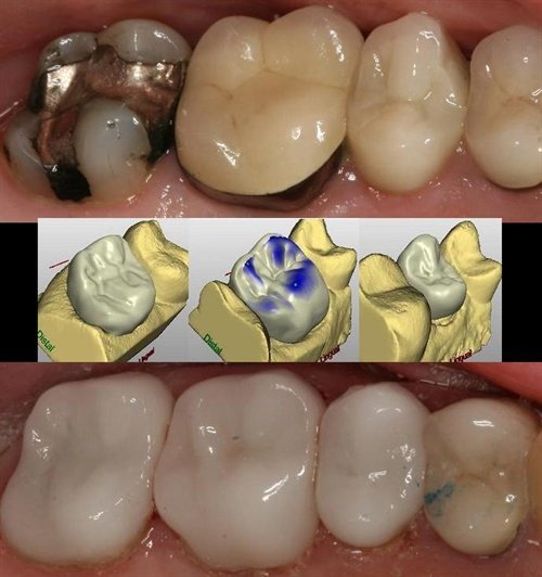 A quadrant of crowns