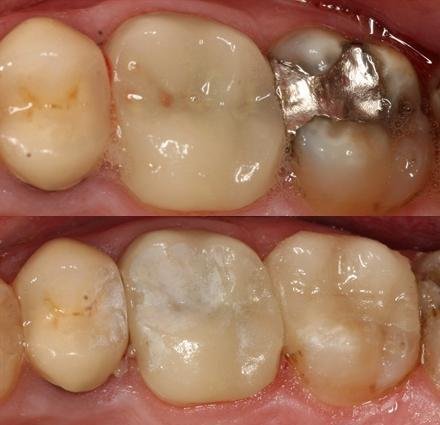 Porcleain onlay replacing failing amalgam