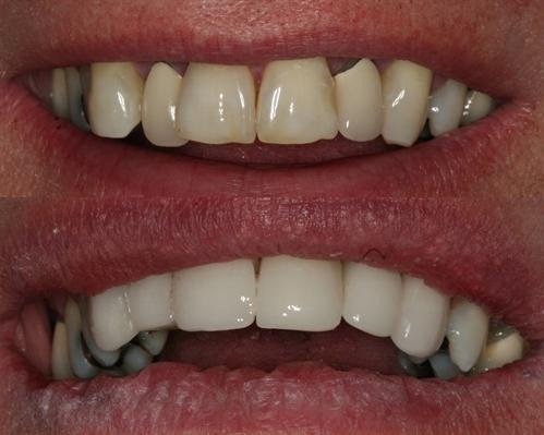 6 cerec crowns