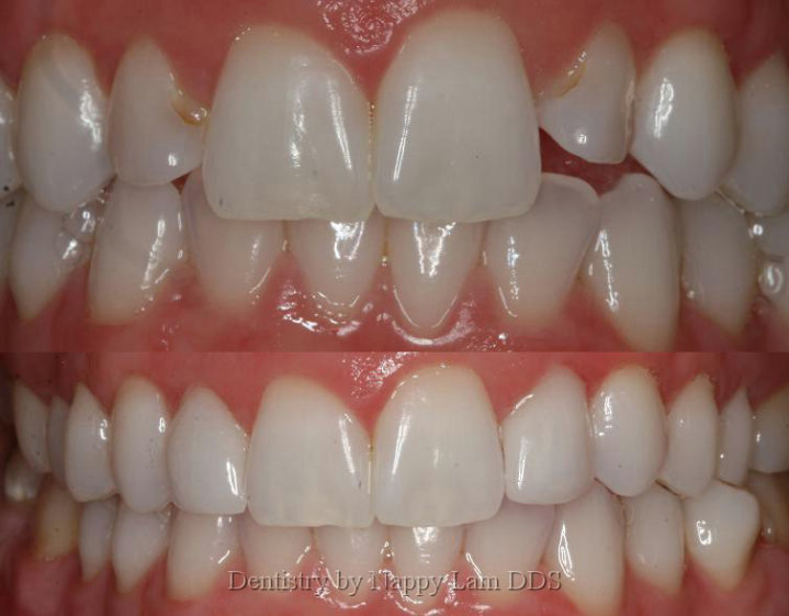 2 Cerec veneers to correct length issues and decay