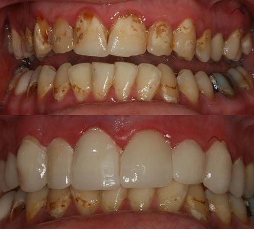 One day cerec smile makeover