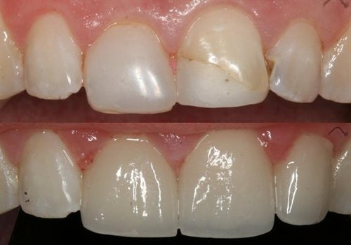 Porcelain crowns to fix decay and failling composite fillings