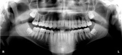 Panoramy X-Ray